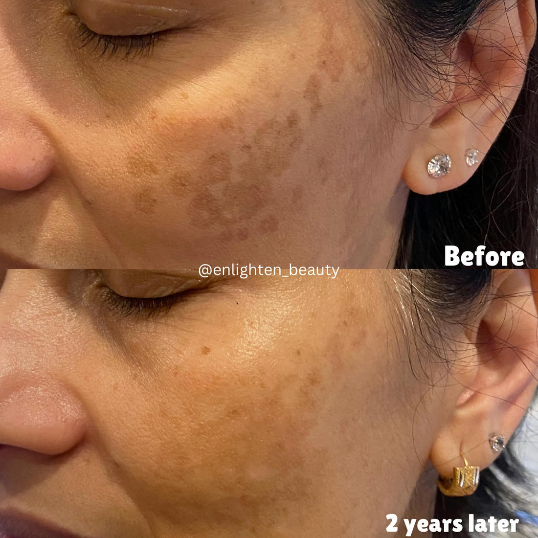 Pigment Is Not the Problem. Inflammation Is